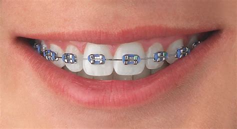 como se colocan los brackets metalicos|que es el bracket.